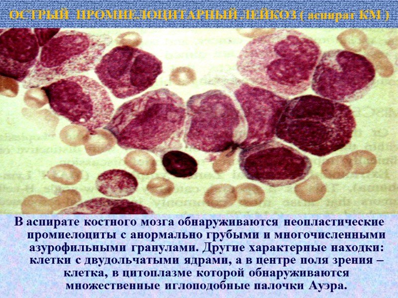 ОСТРЫЙ  ПРОМИЕЛОЦИТАРНЫЙ ЛЕЙКОЗ ( аспират КМ ) В аспирате костного мозга обнаруживаются неопластические